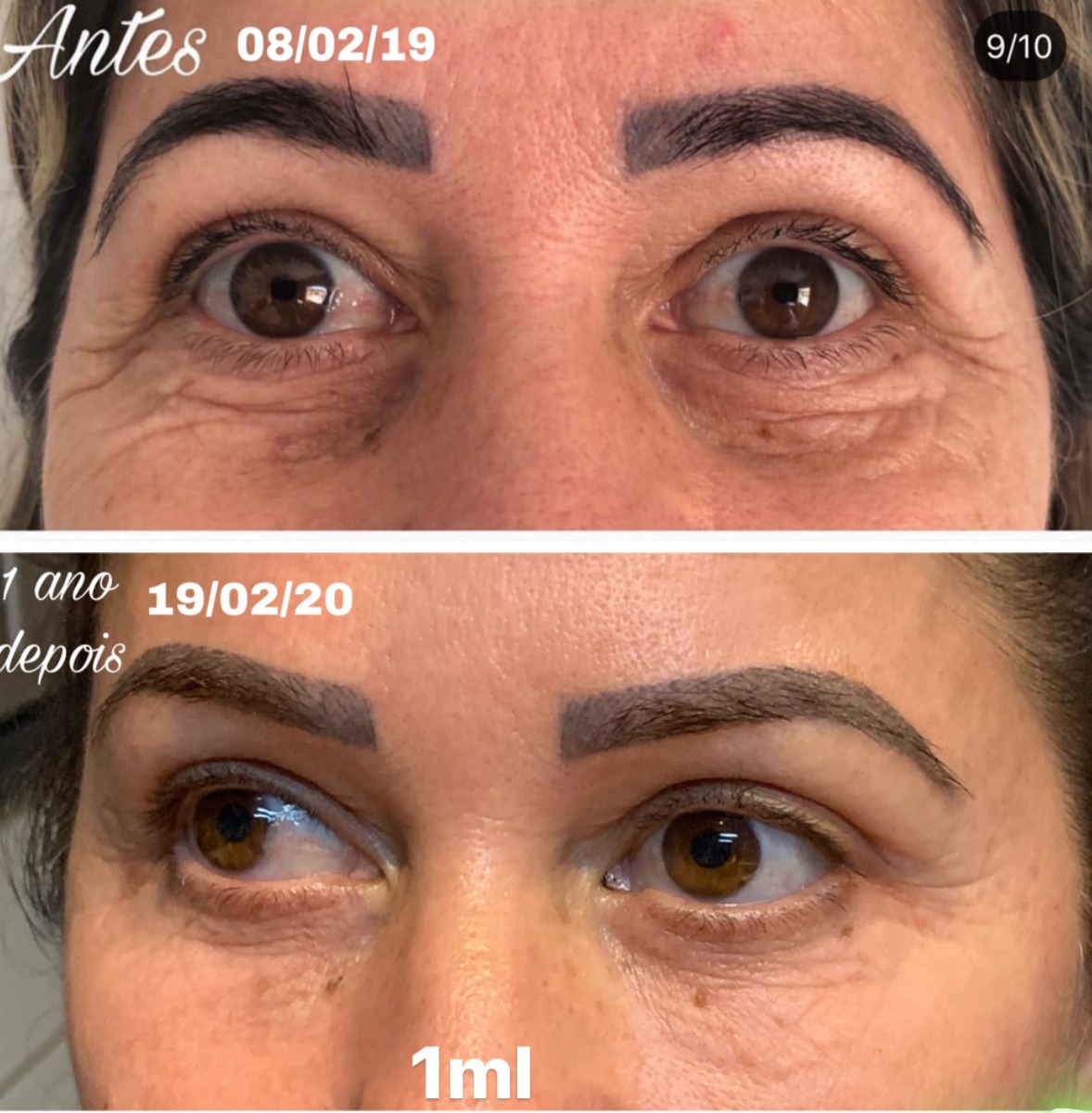 Preenchimento olheiras / calha lacrimal
