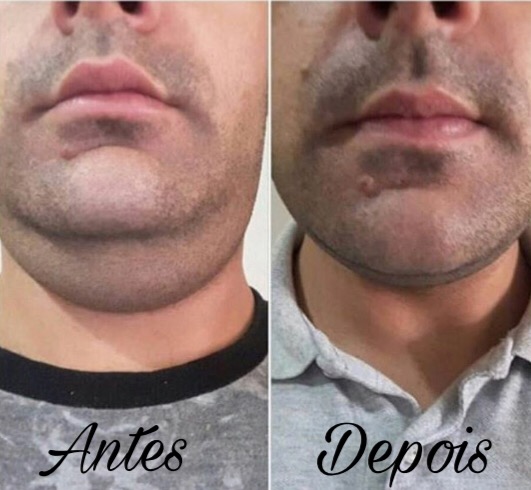Lipo papada com aplicação de ativos