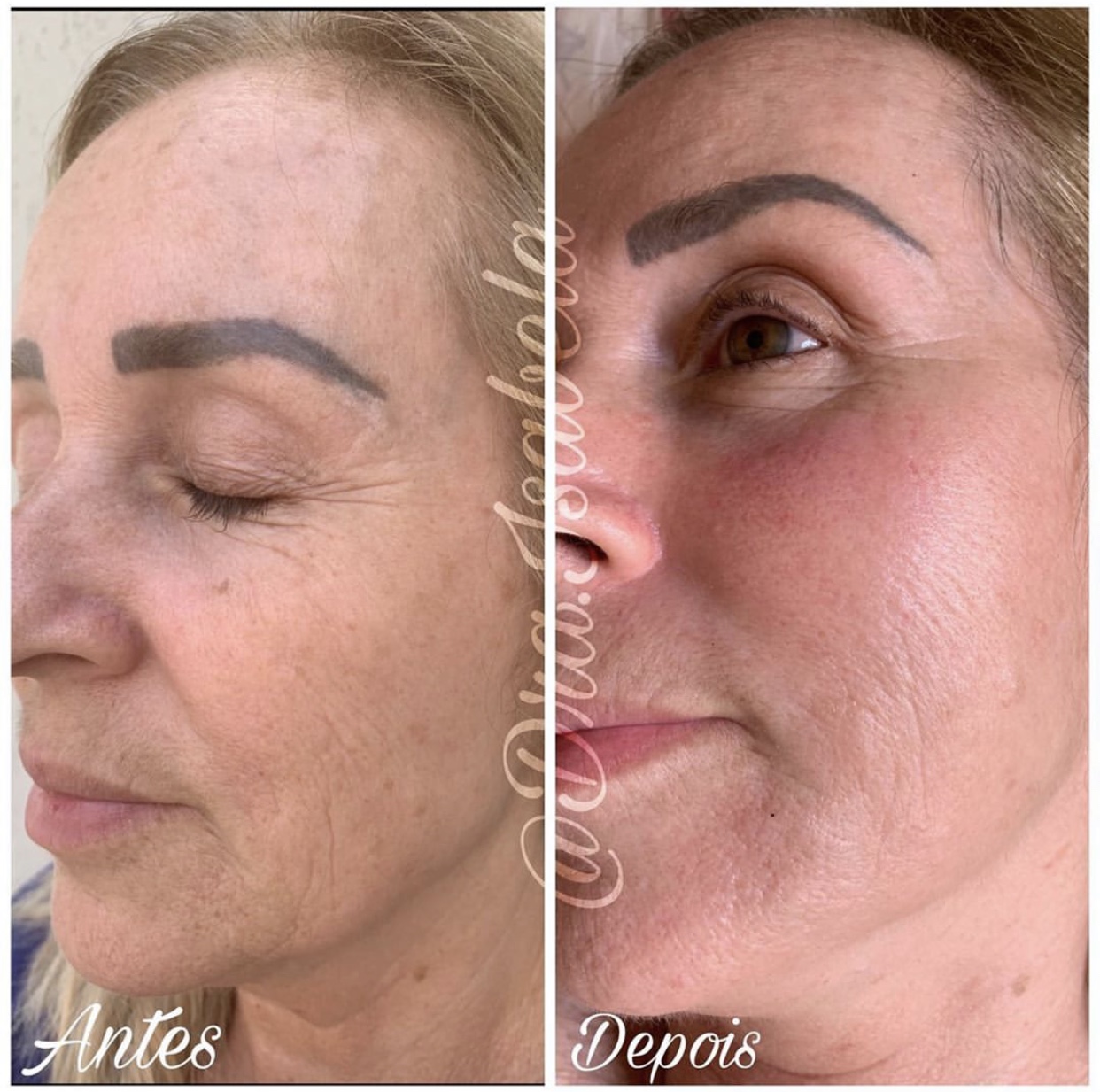Peeling de renovação